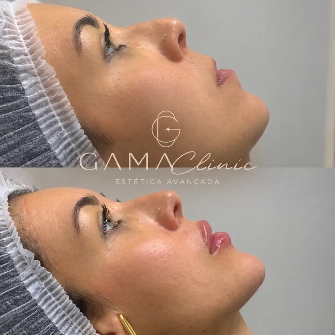 Antes e depois facial