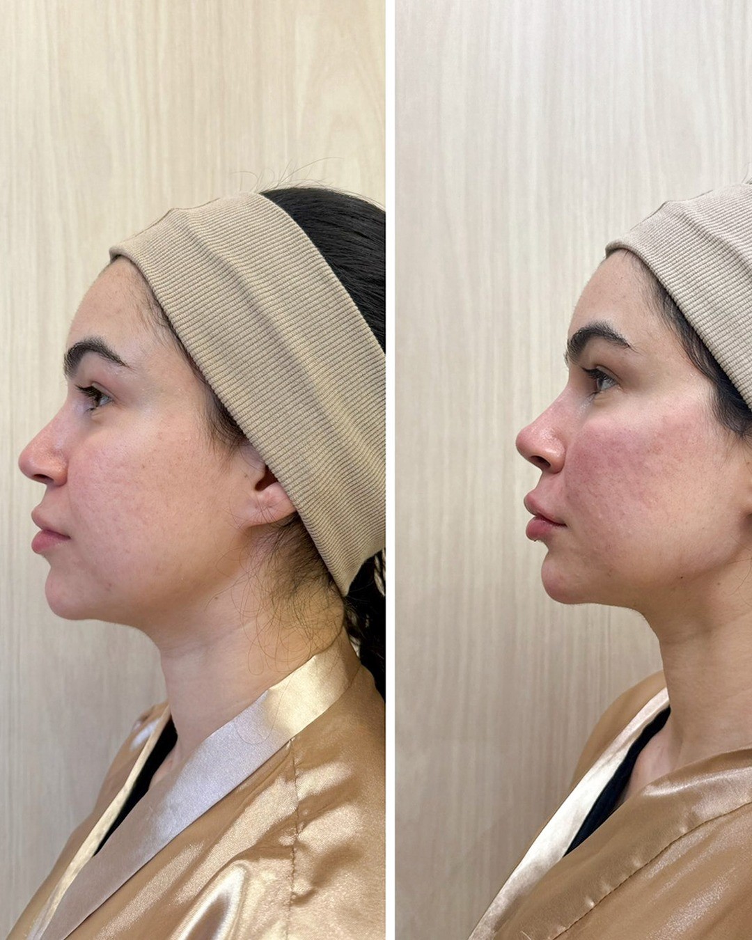 Antes e depois do perfil facial
